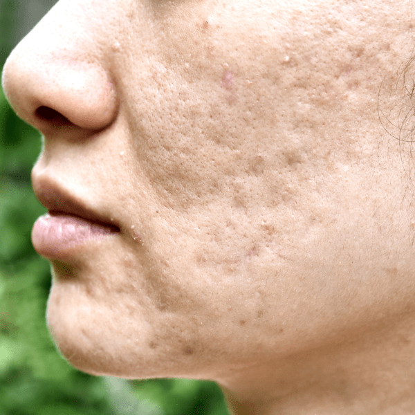 Facial scars treatment